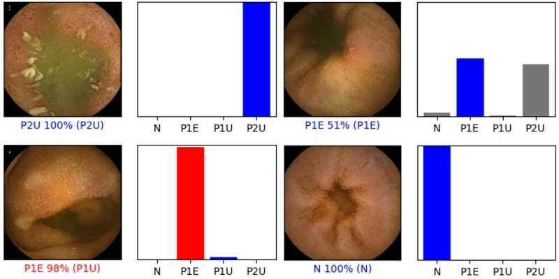 Figure 1 – Convolutional neural network output. N – normal mucosa; P1E – erosions with intermediate bleeding risk; P1U – ulcers with intermediate bleeding risk; P2U – ulcers with high bleeding risk