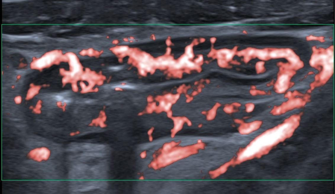 Wall hyperaemia (Limberg Score 3), from the same baseline GIUS