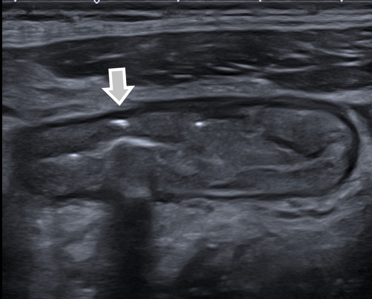 Deep wall colonic ulcer, in a baseline GIUS. We also observe focal loss of wall stratification.